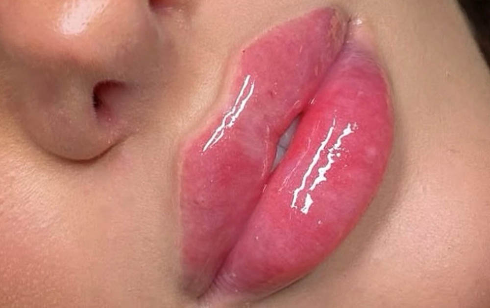 Lip Enhancements